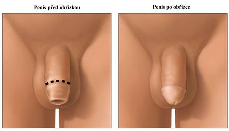 Penis před a po obřízce