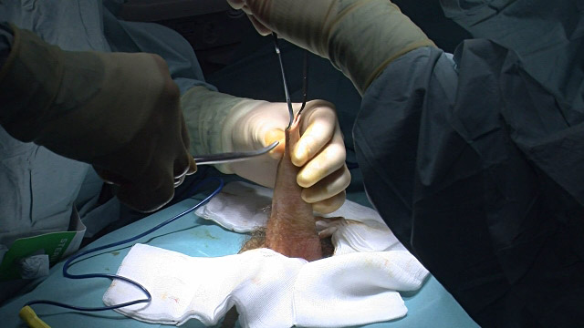 Mužská obřízka patří mezi jednodušší zákroky, které mohou kromě plastických chirurgů provádět i urologové.