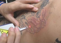 Laserem si můžete nechat vyrobit krásně přesnou jemnou jizvu. Laserem si můžete nechat vyrobit krásně přesnou jemnou jizvu.