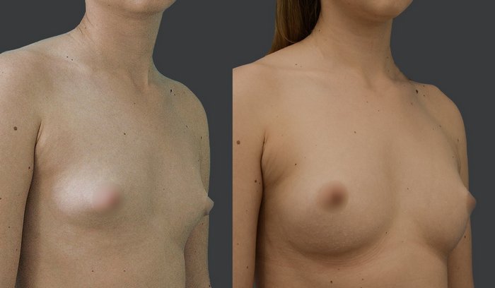 augumentace prsou autotransplantací tuku