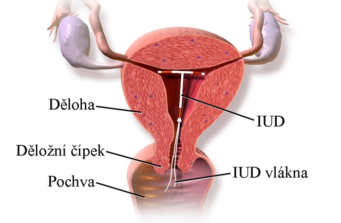 nitroděložní tělísko v děloze