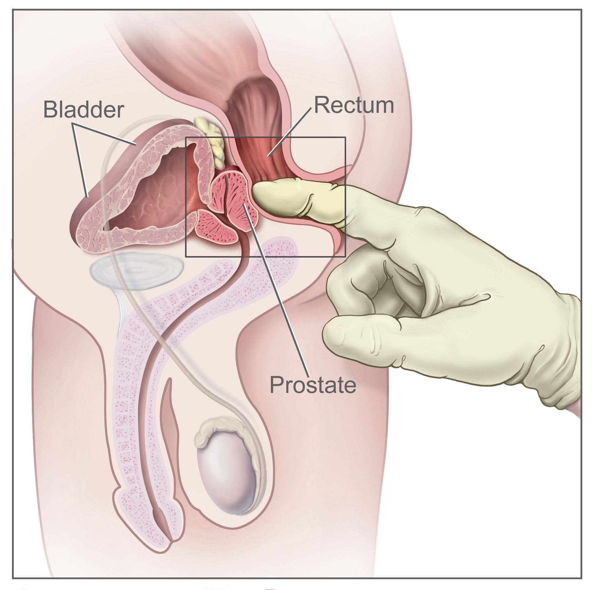 Kde nahmatat prostatu