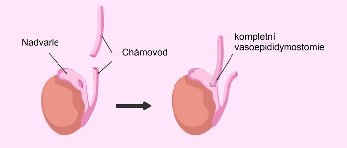 Vasoepididymostomie - napojení chámovodu na nadvarle 