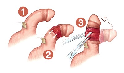Operace zahnutého penisu