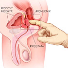 Přímá masáž prostaty se provádí přes konečník.