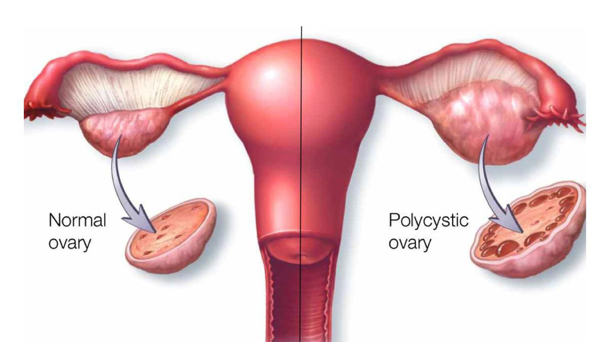Syndrom polycystických vaječníků