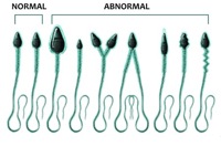 Normální a špatně vyvinuté spermie.