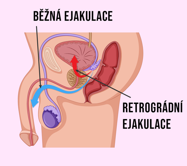 Schéma retrográdní ejakulace