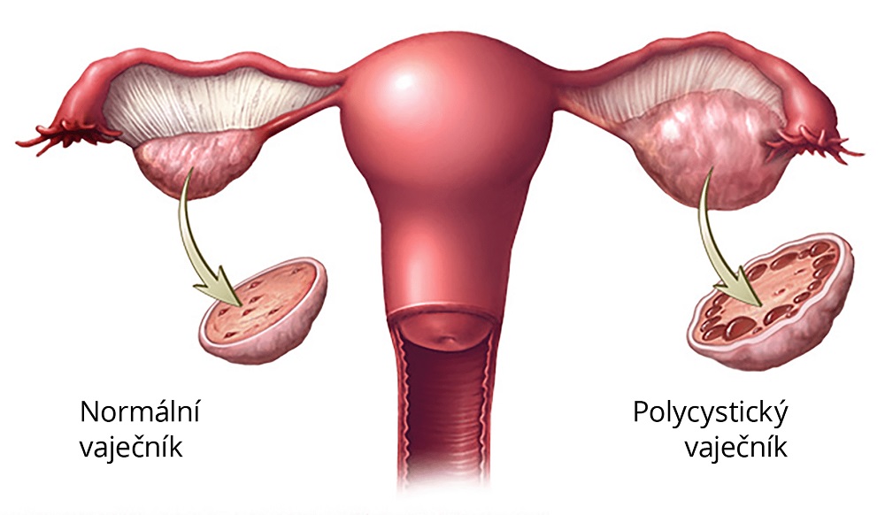 Syndrom polycystických ovarií/vaječníků, PCOS